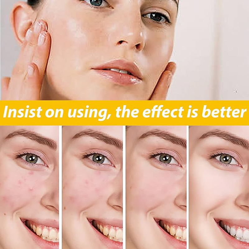 Eelhoe - Cystic Acne Cream (30ML)
